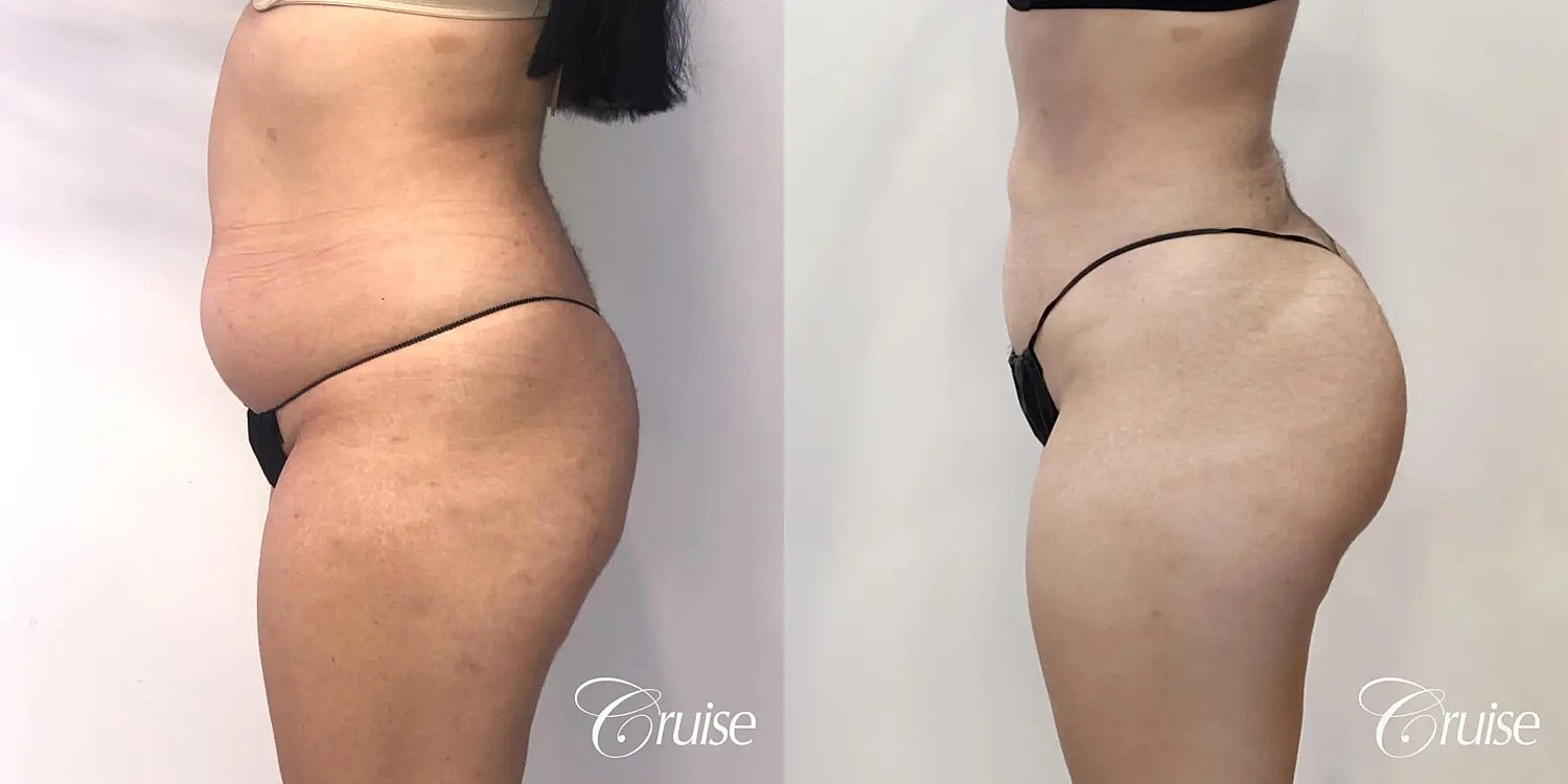 Liposuction Before & After