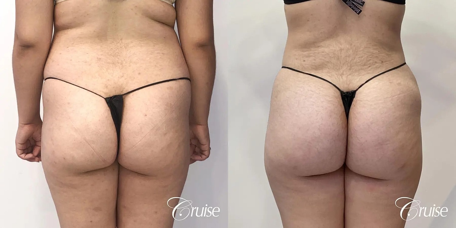 Liposuction Before & After