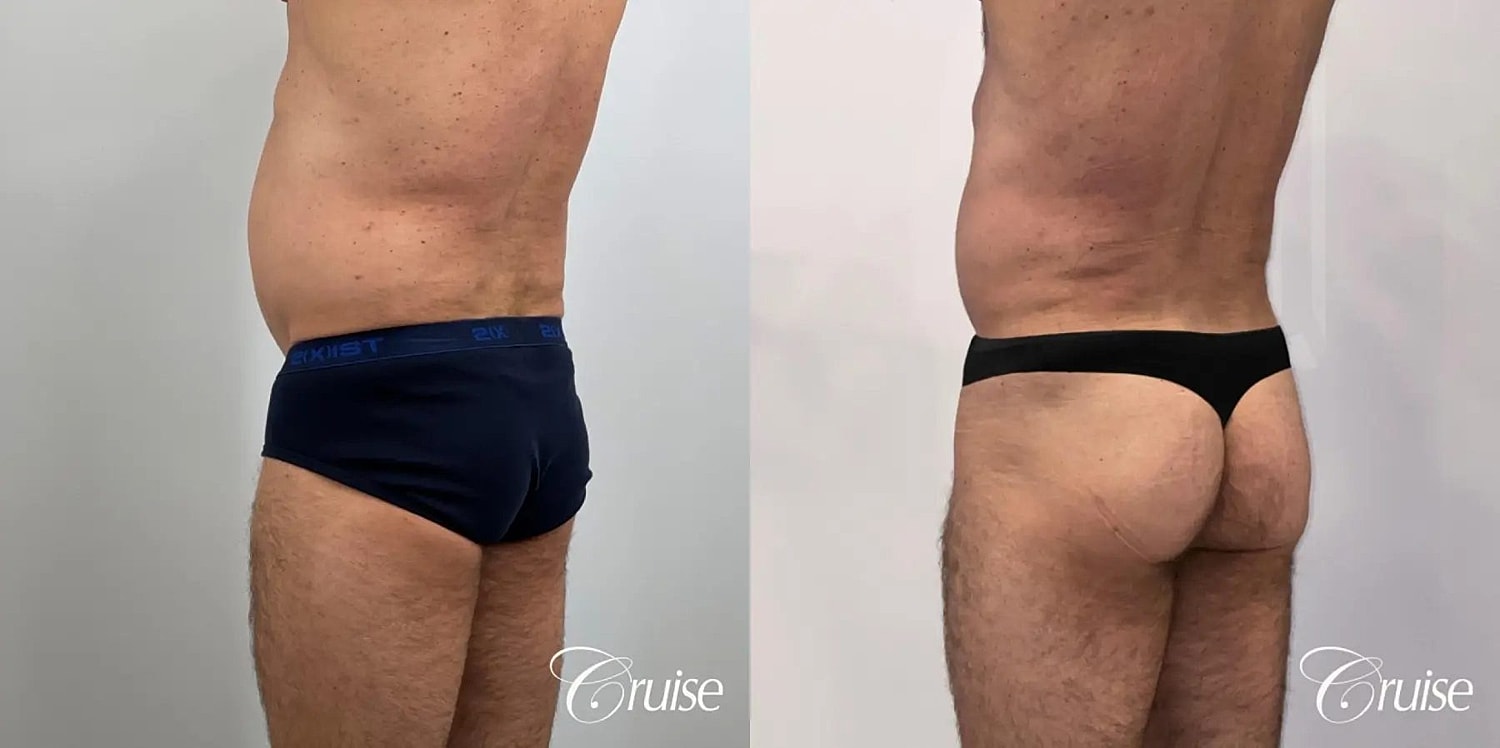 Liposuction Before & After