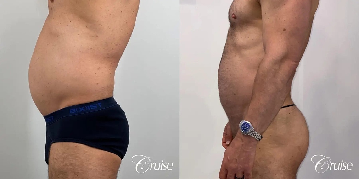 Liposuction Before & After