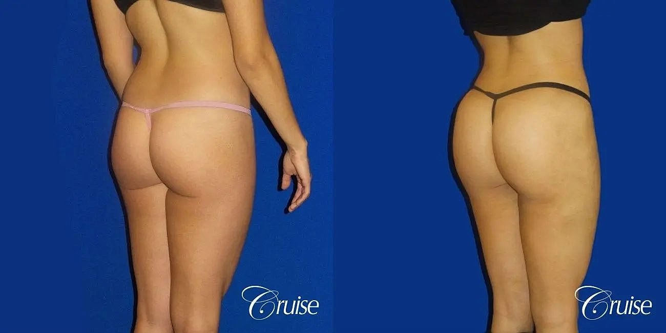 Liposuction Before & After