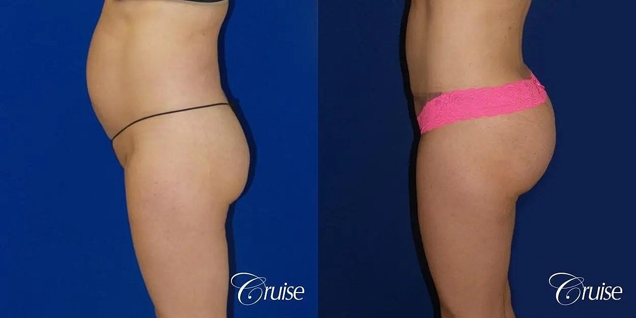 Liposuction Before & After