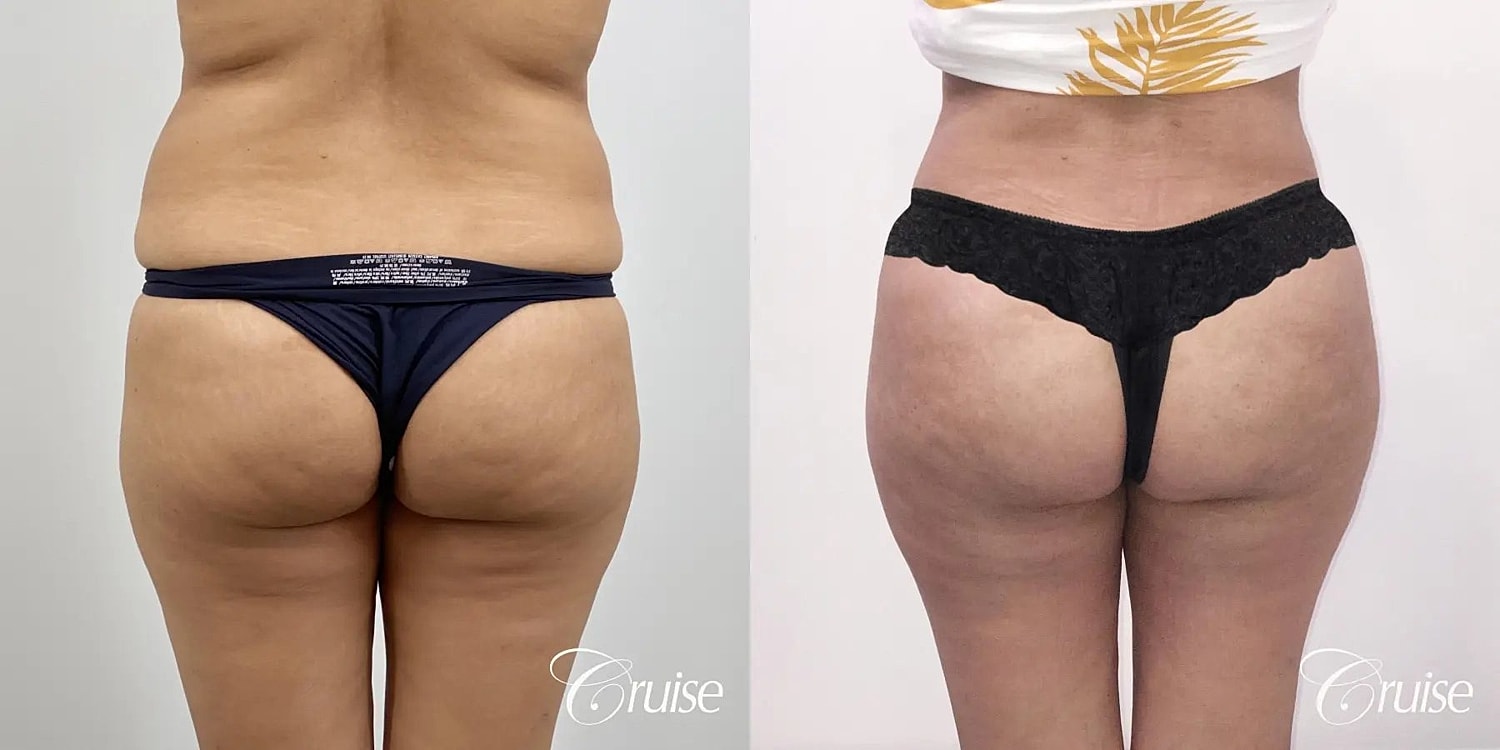 Liposuction Before & After