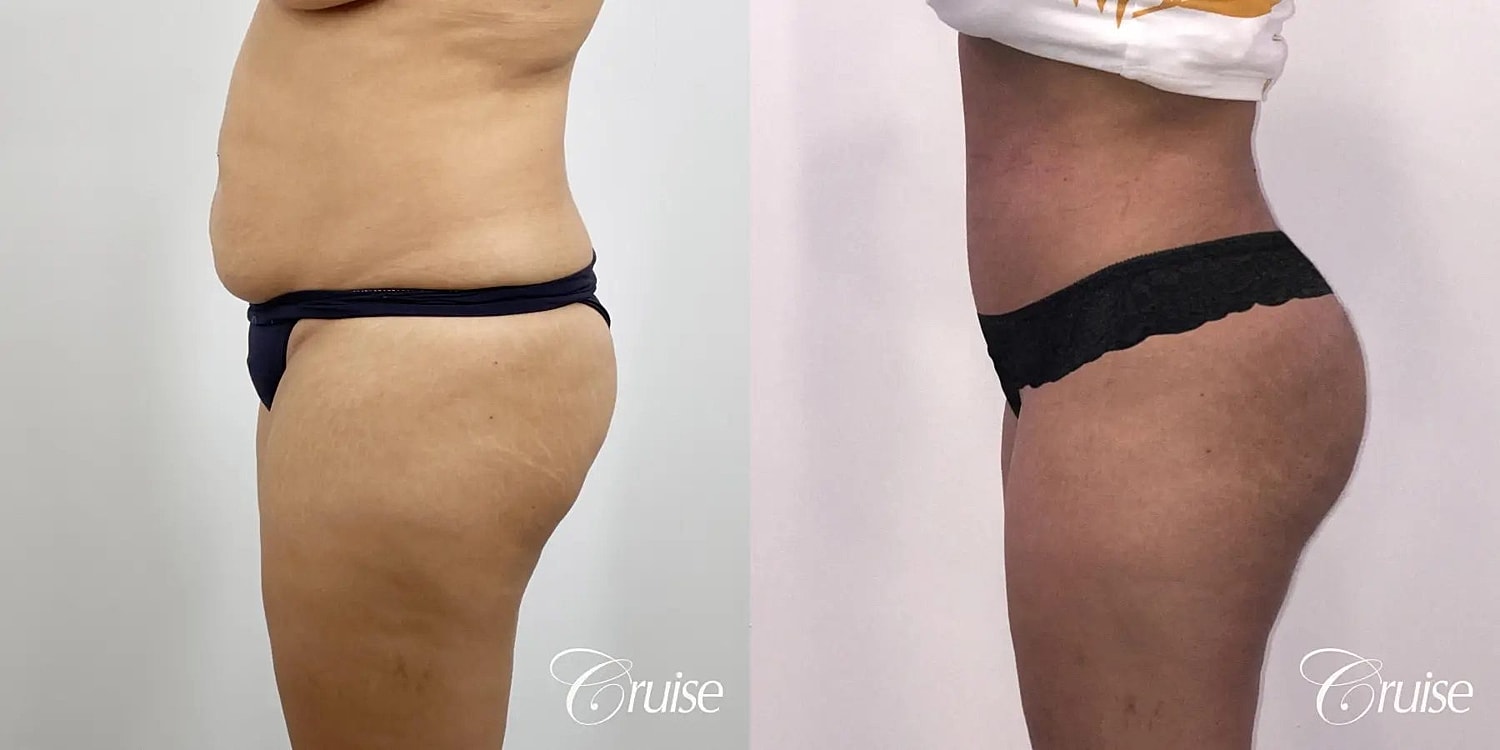 Liposuction Before & After