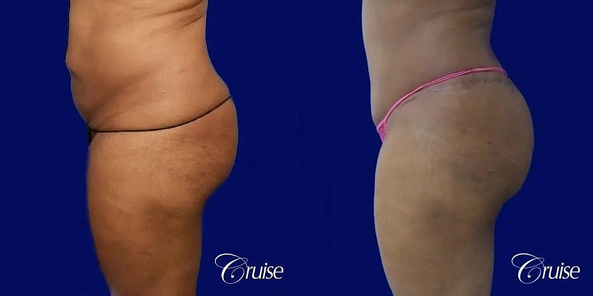 Liposuction Before & After