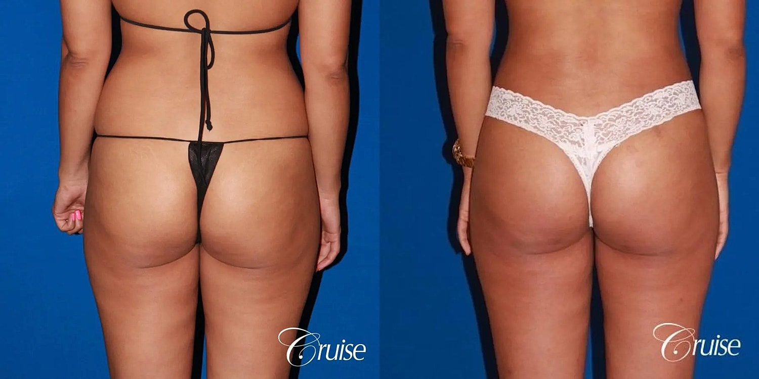 Liposuction Before & After