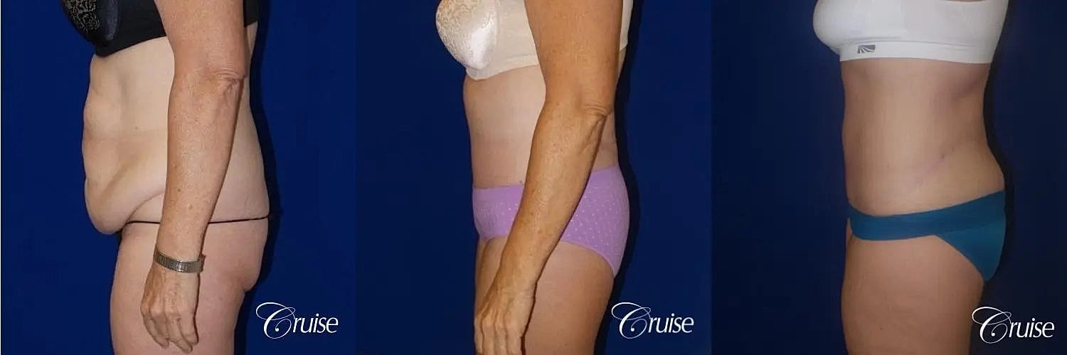Liposuction Before & After