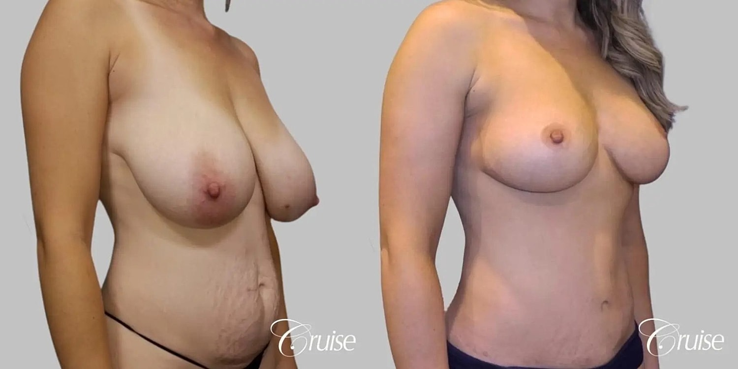 Breast Reduction Before & After