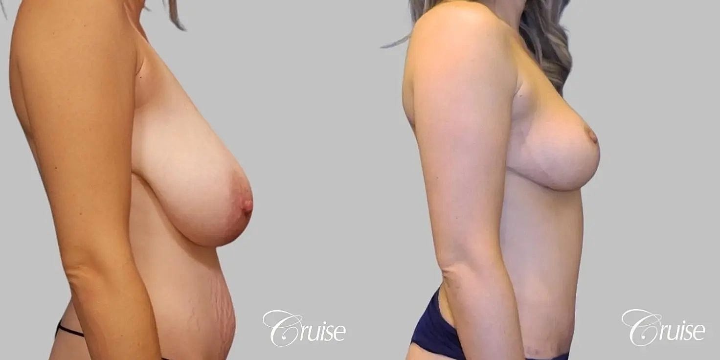 Breast Reduction Before & After