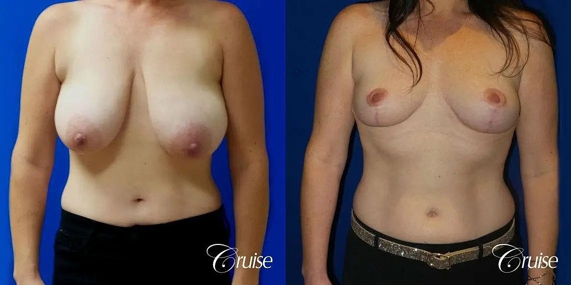Breast Reduction Before & After