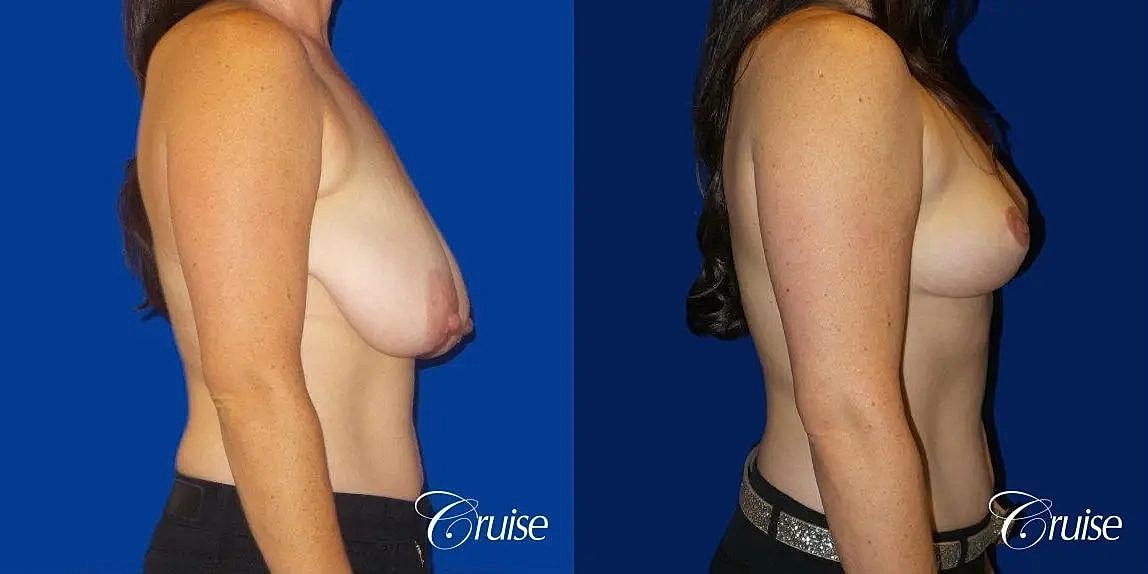 Breast Reduction Before & After