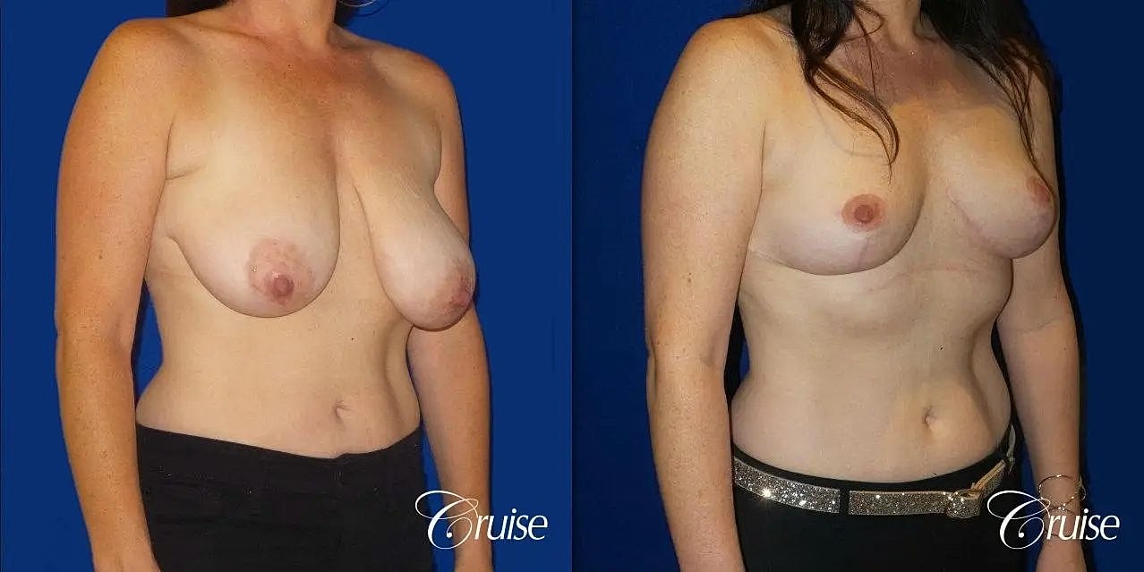 Breast Reduction Before & After