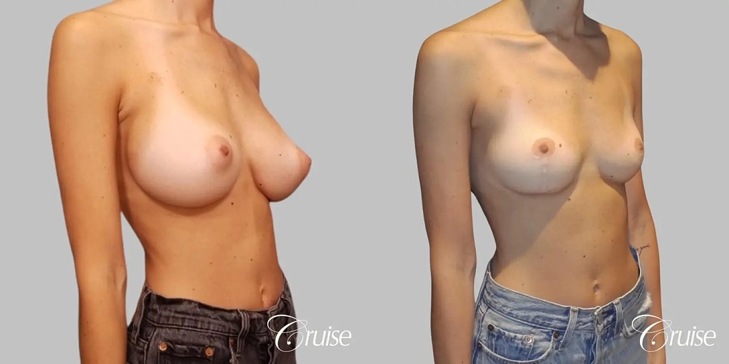 Breast Reduction Before & After
