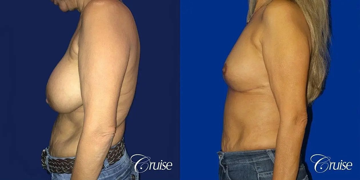 Breast Reduction Before & After