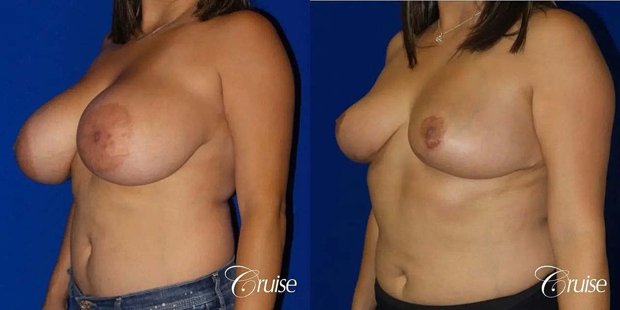 Breast Reduction Before & After
