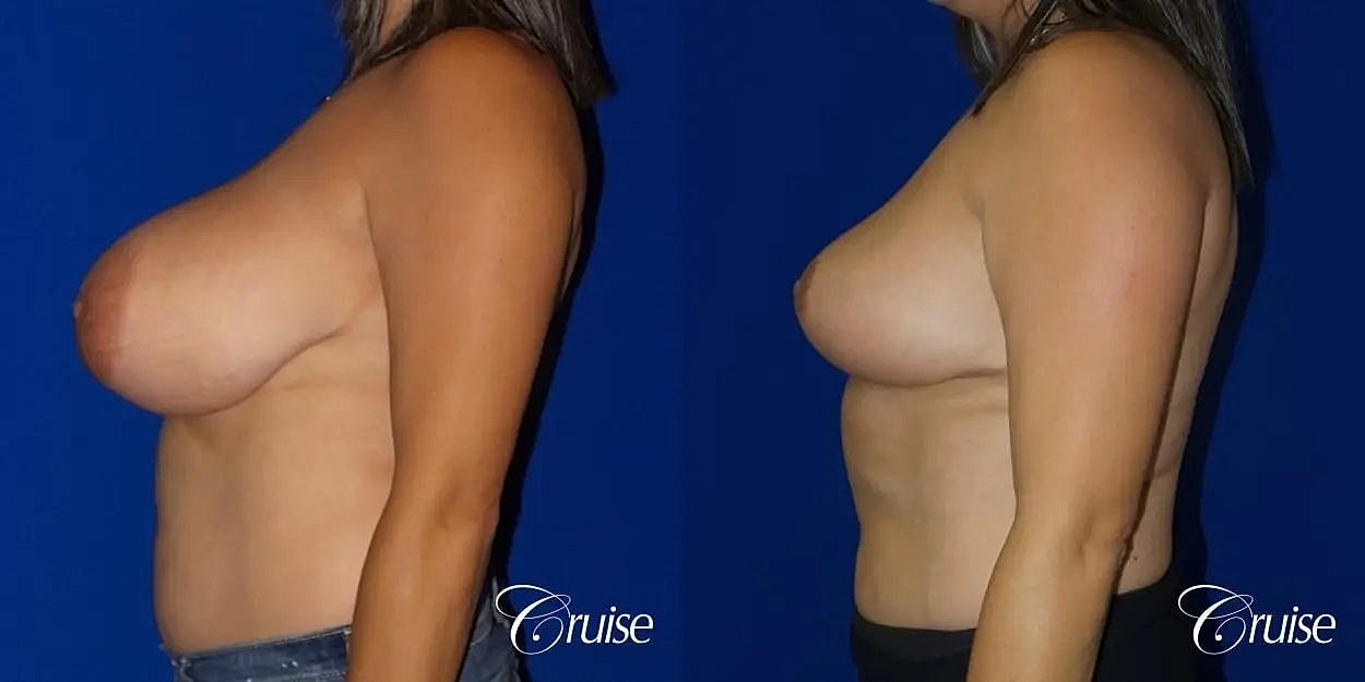 Breast Reduction Before & After
