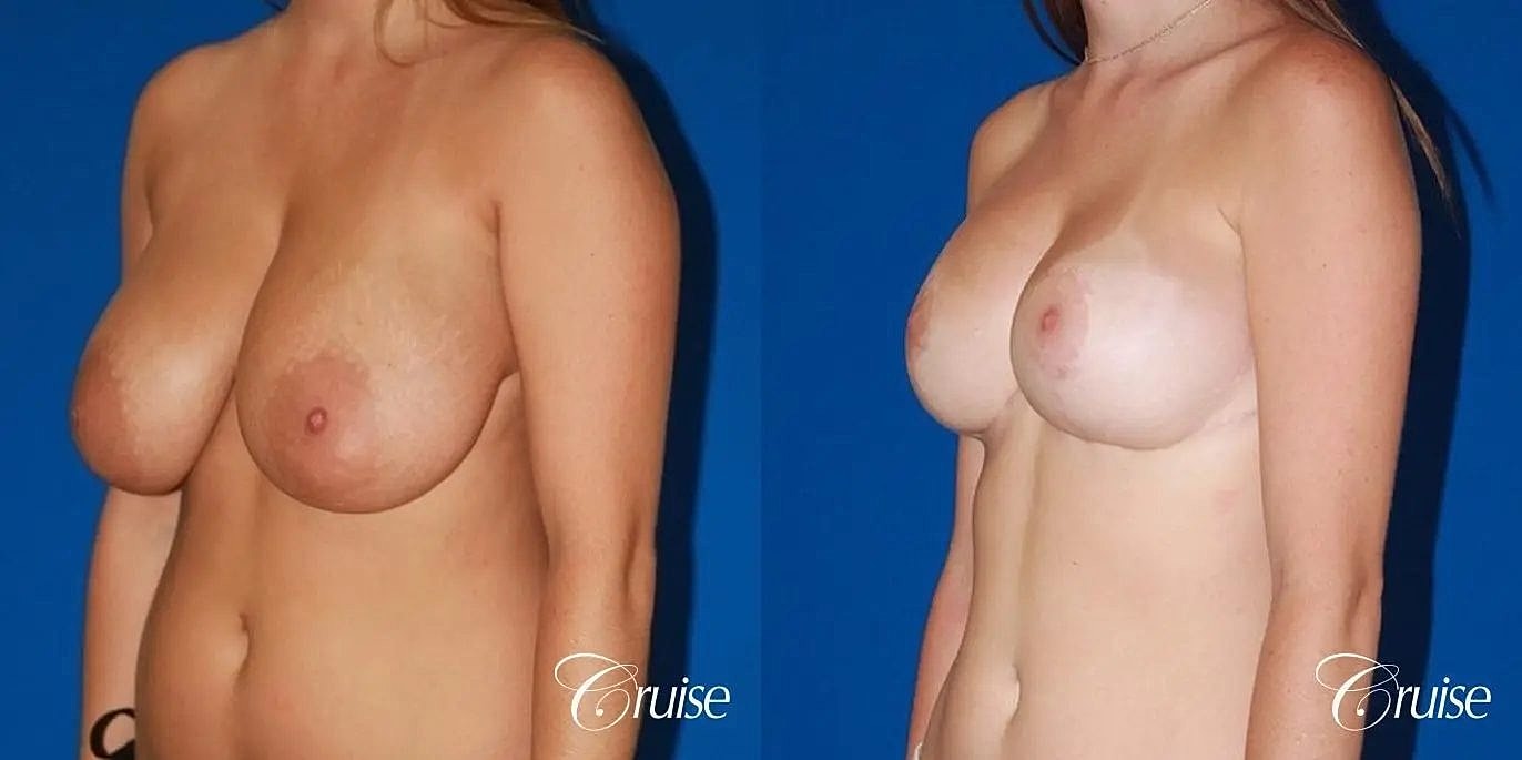 Breast Reduction Before & After