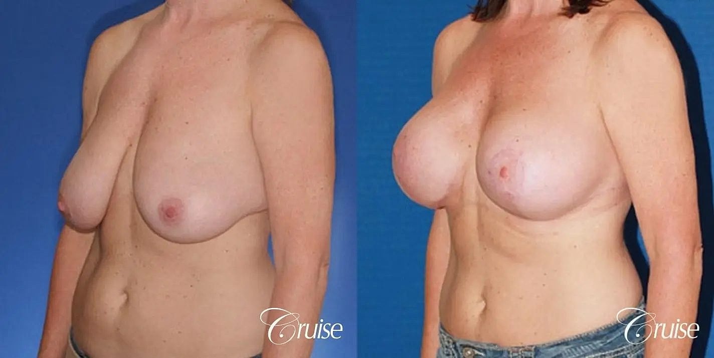 Breast Reduction Before & After
