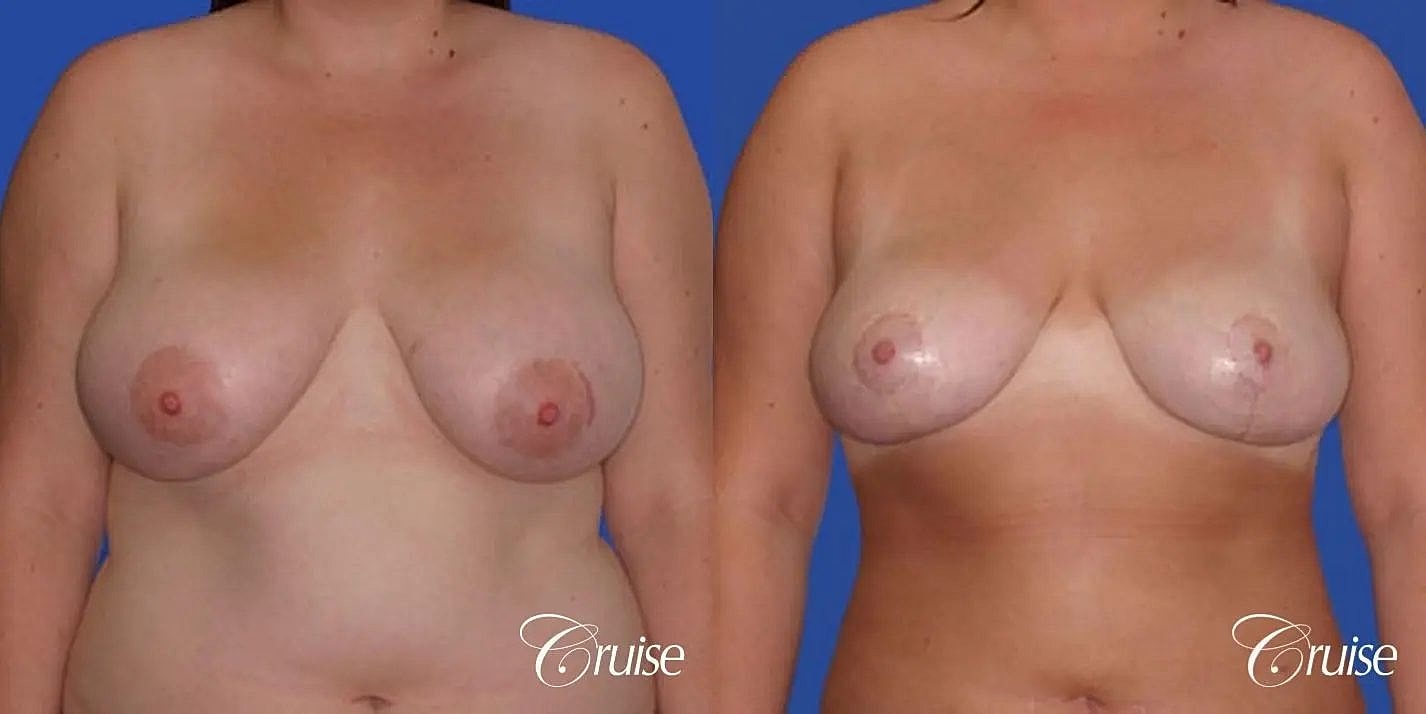 Breast Reduction Before & After