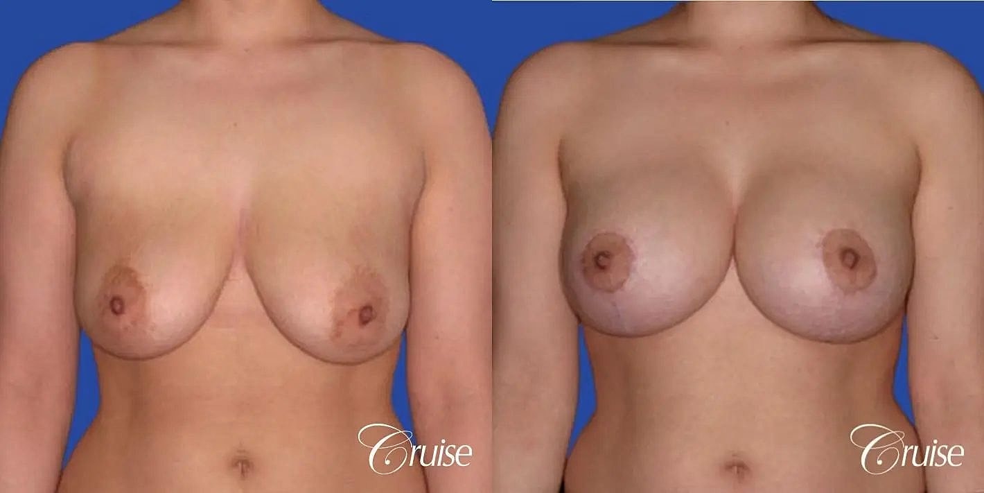 Breast Reduction Before & After