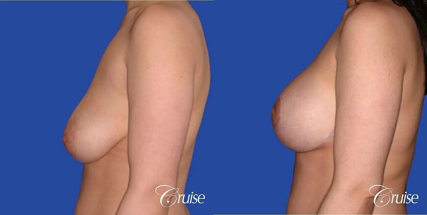 Breast Reduction Before & After