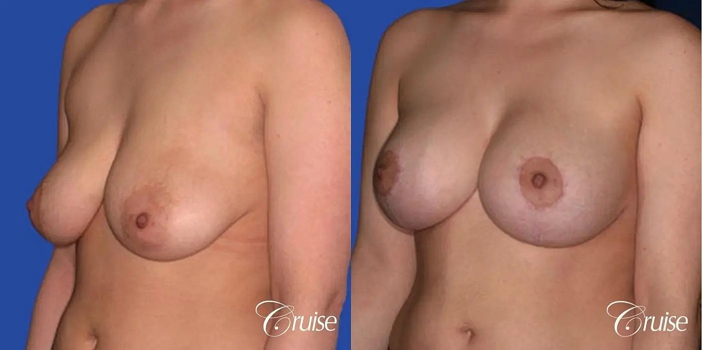 Breast Reduction Before & After