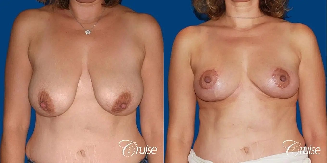 Breast Reduction Before & After