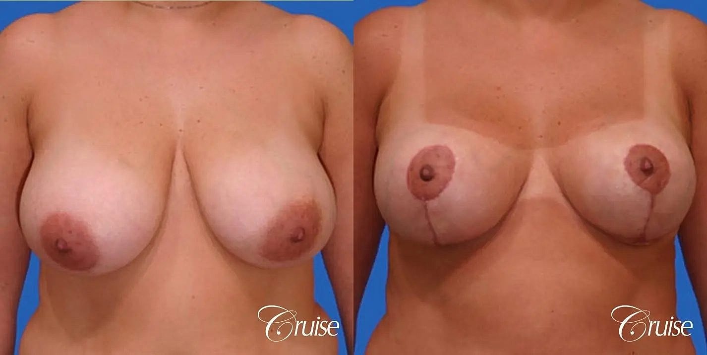 Breast Reduction Before & After