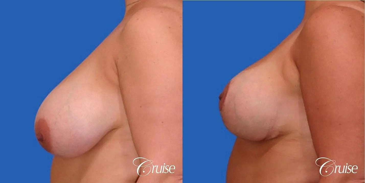 Breast Reduction Before & After