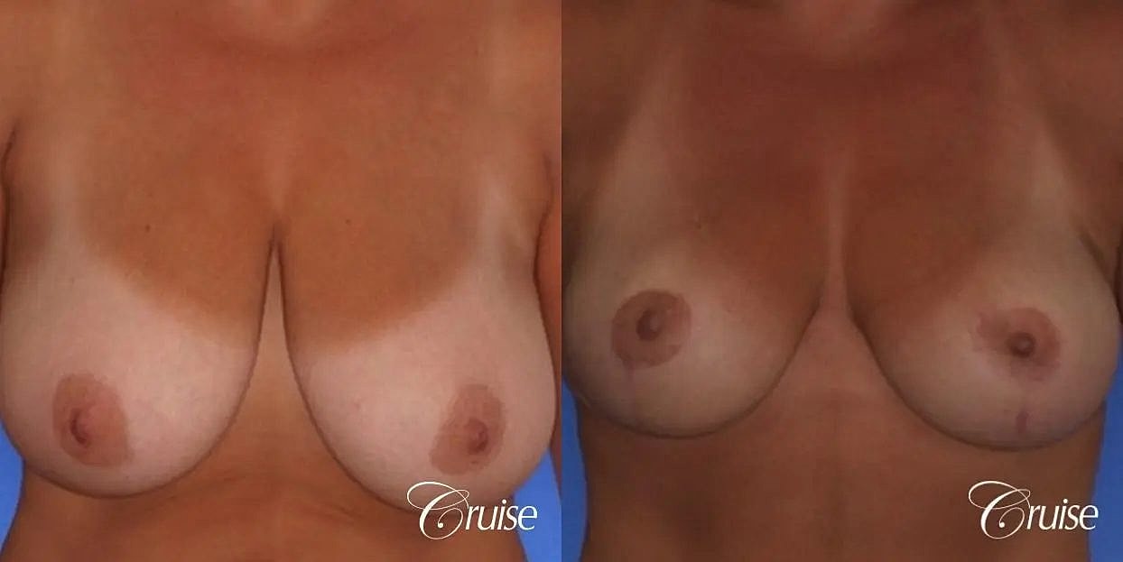 Breast Reduction Before & After