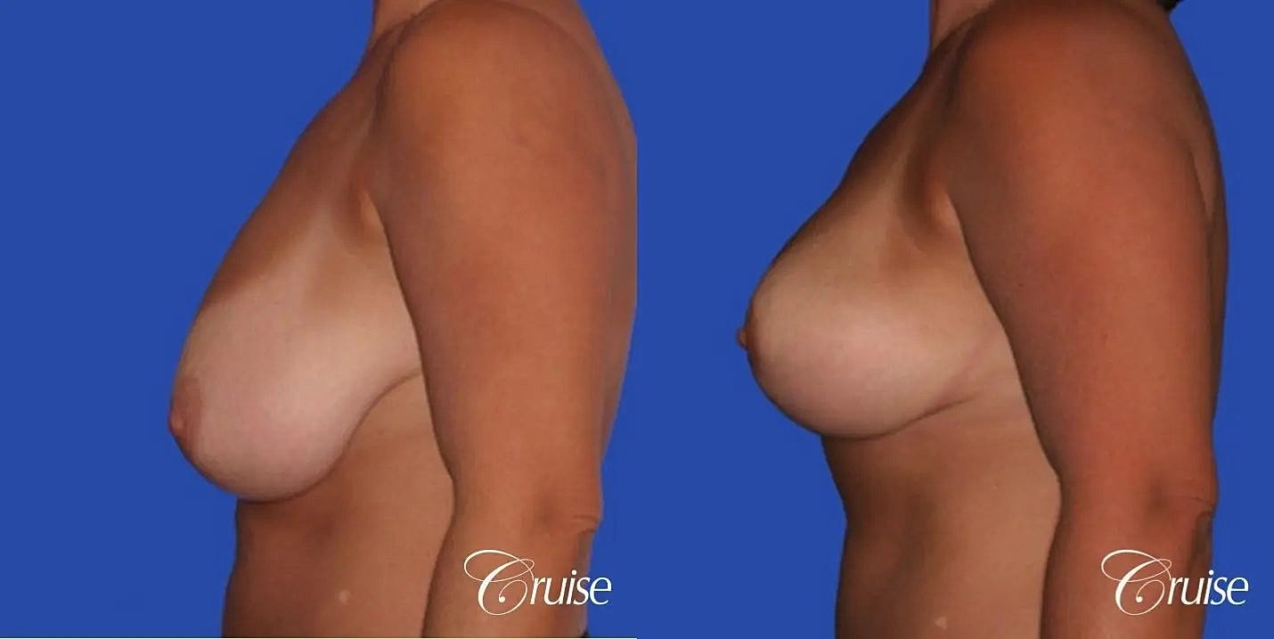 Breast Reduction Before & After