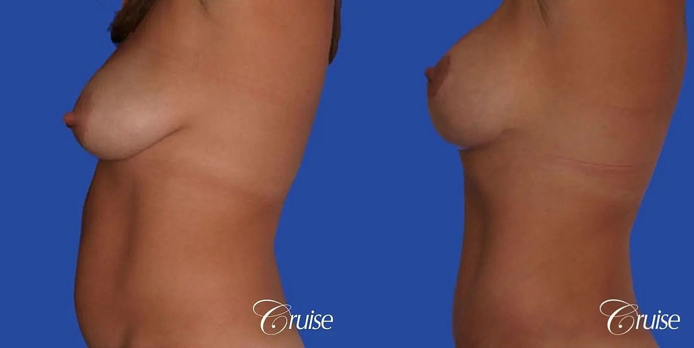 Breast Reduction Before & After