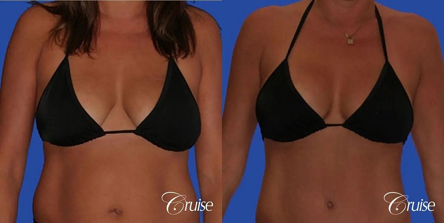 Breast Reduction Before & After
