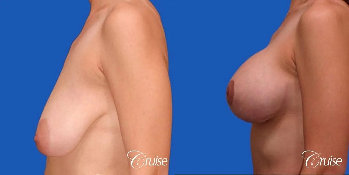 Breast Reduction Before & After
