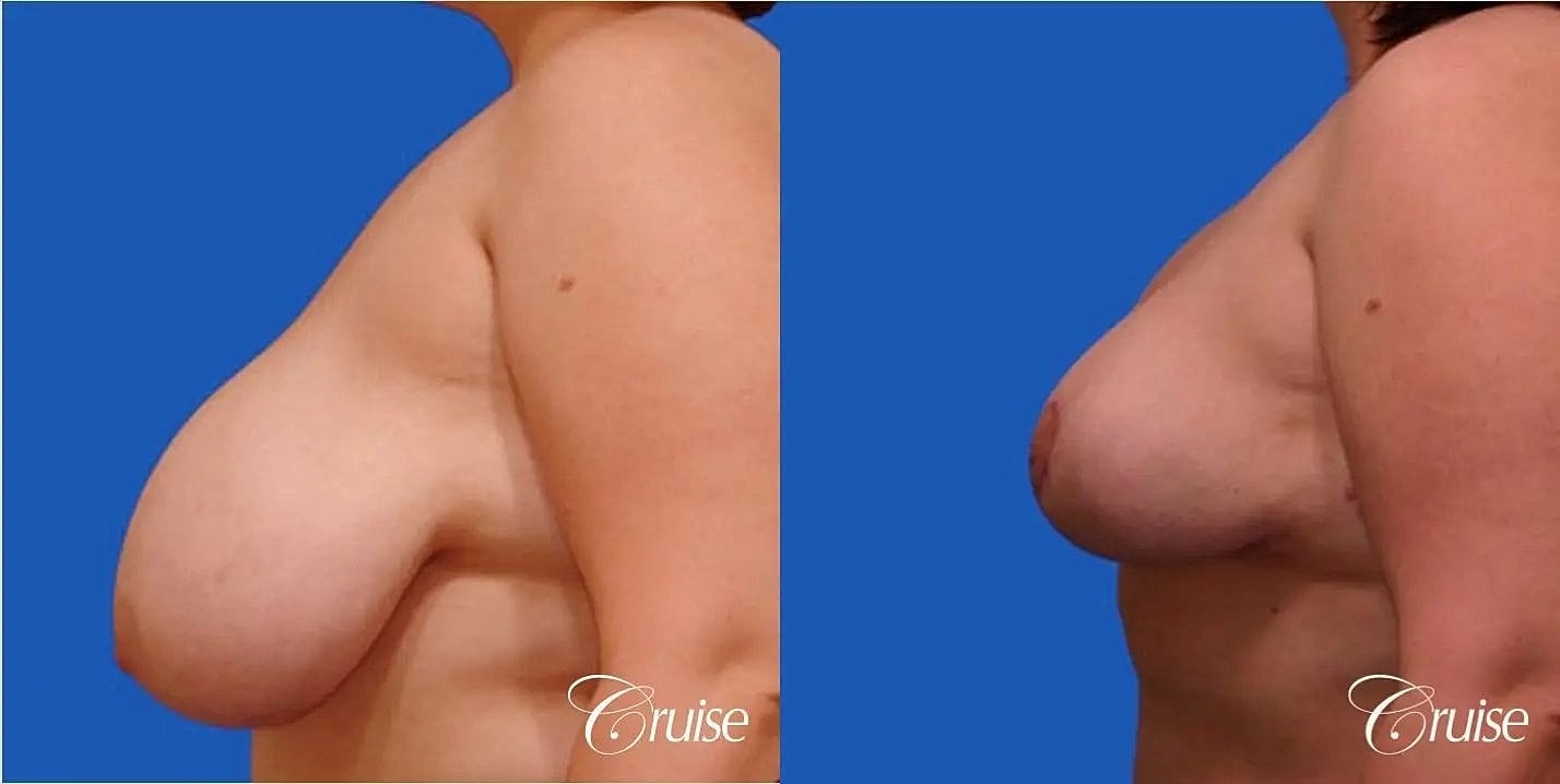 Breast Reduction Before & After