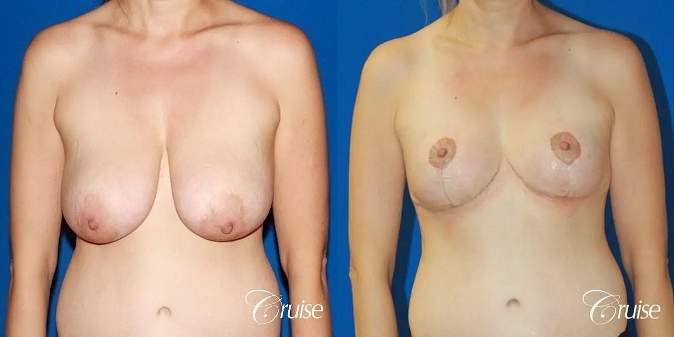 Breast Reduction Before & After