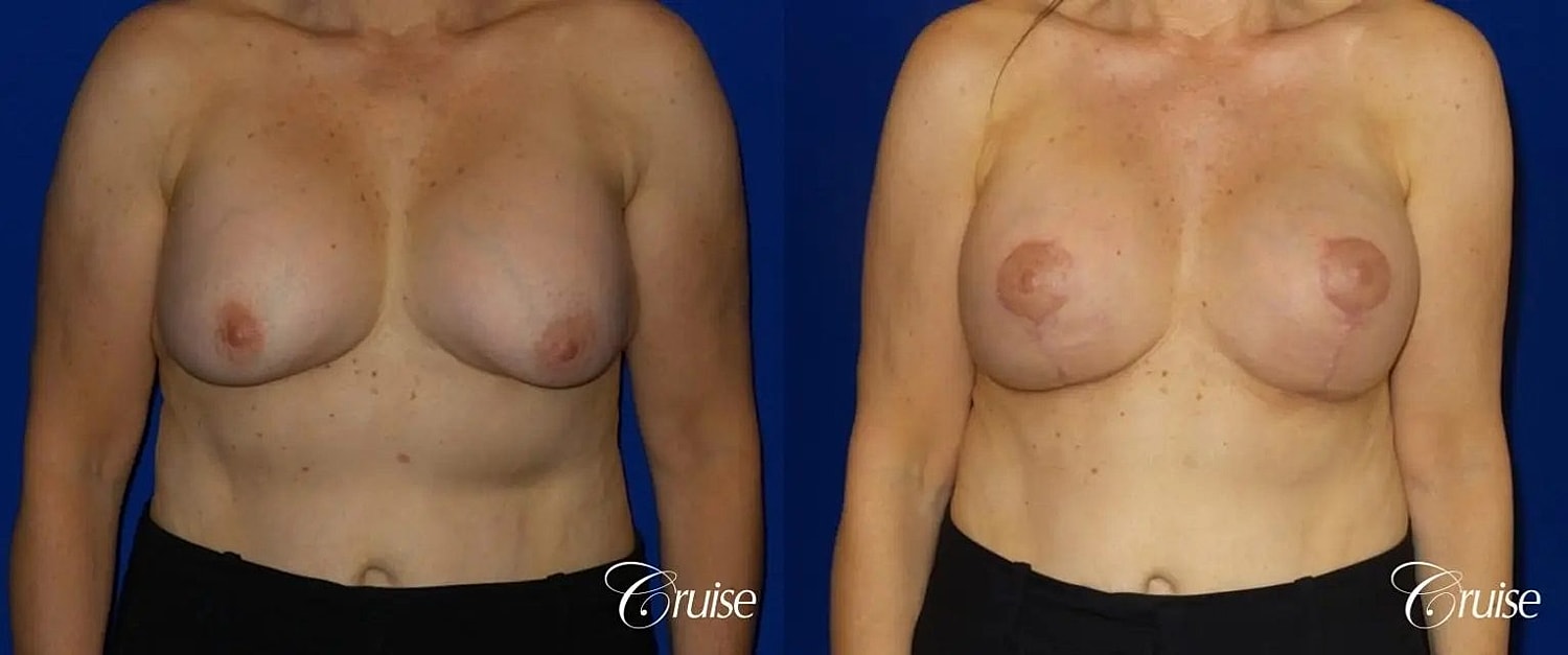 Breast Reduction Before & After