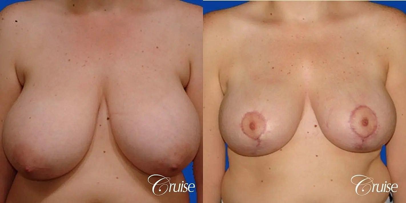 Breast Reduction Before & After