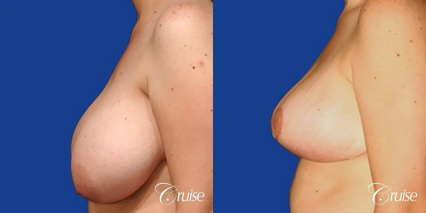 Breast Reduction Before & After
