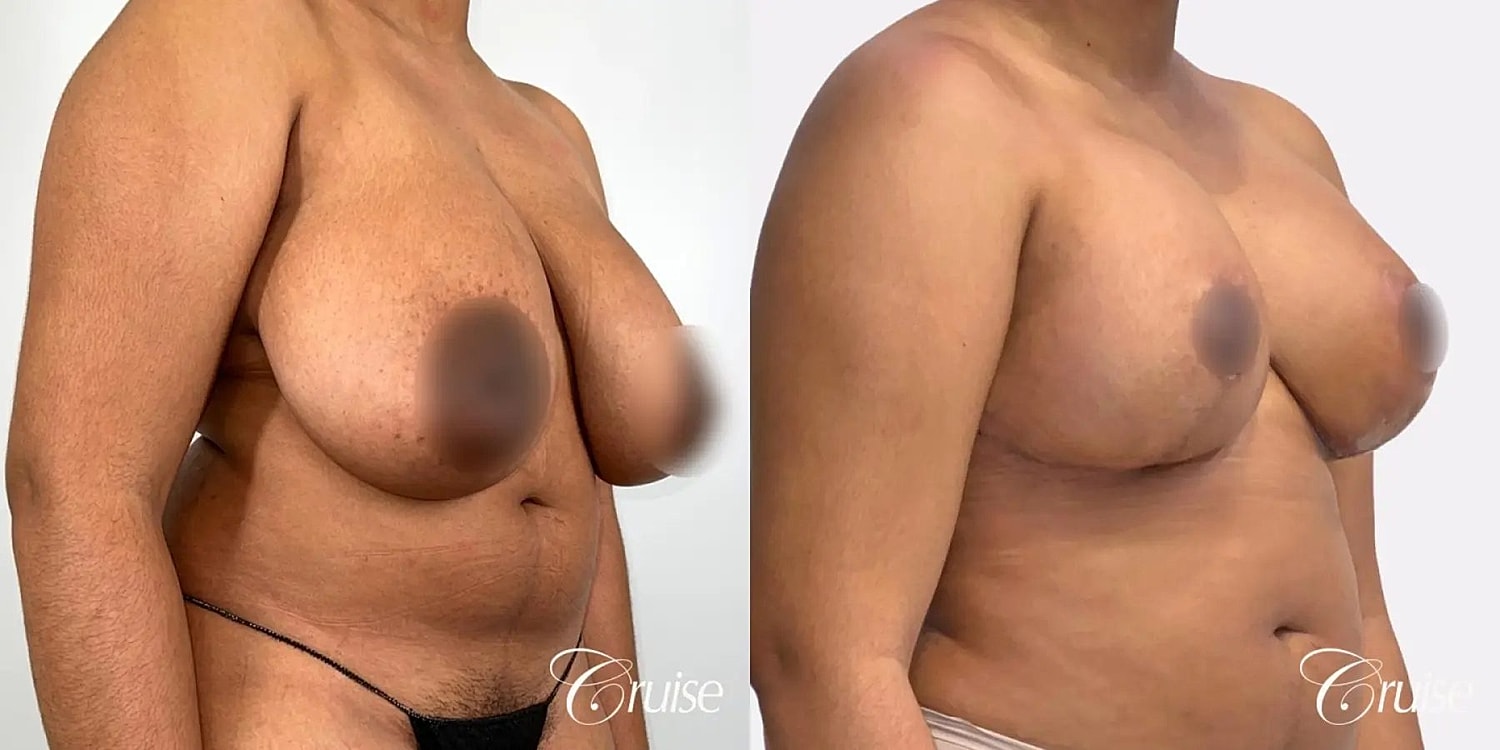 Breast Reduction Before & After