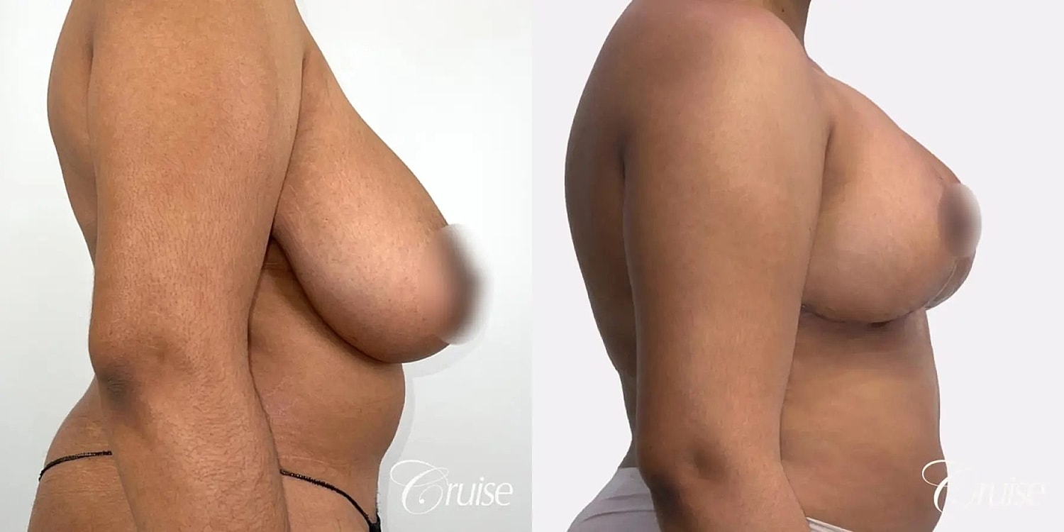 Breast Reduction Before & After