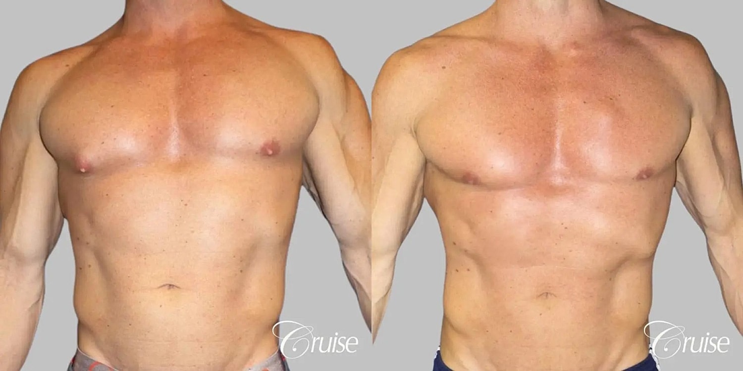 Gynecomastia Surgery Before & After