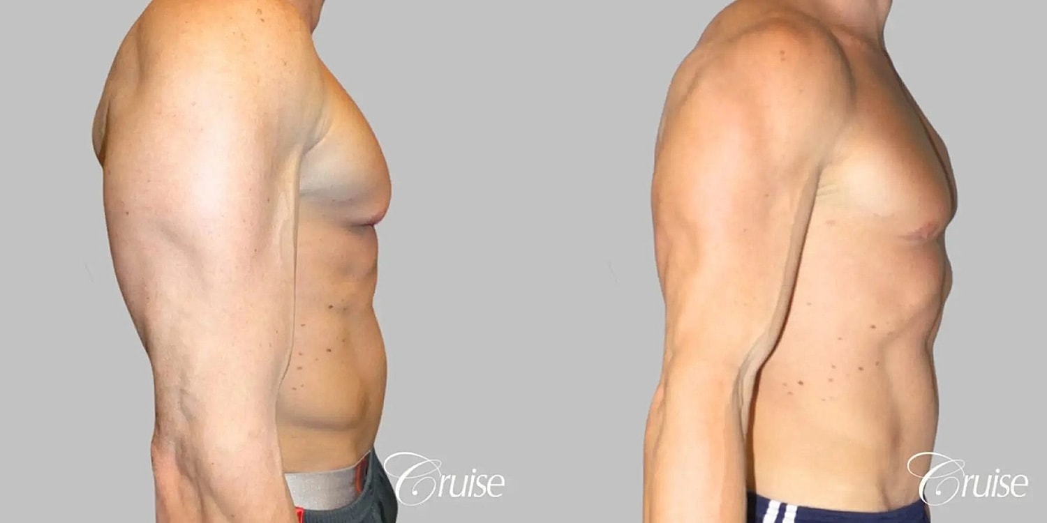 Gynecomastia Surgery Before & After
