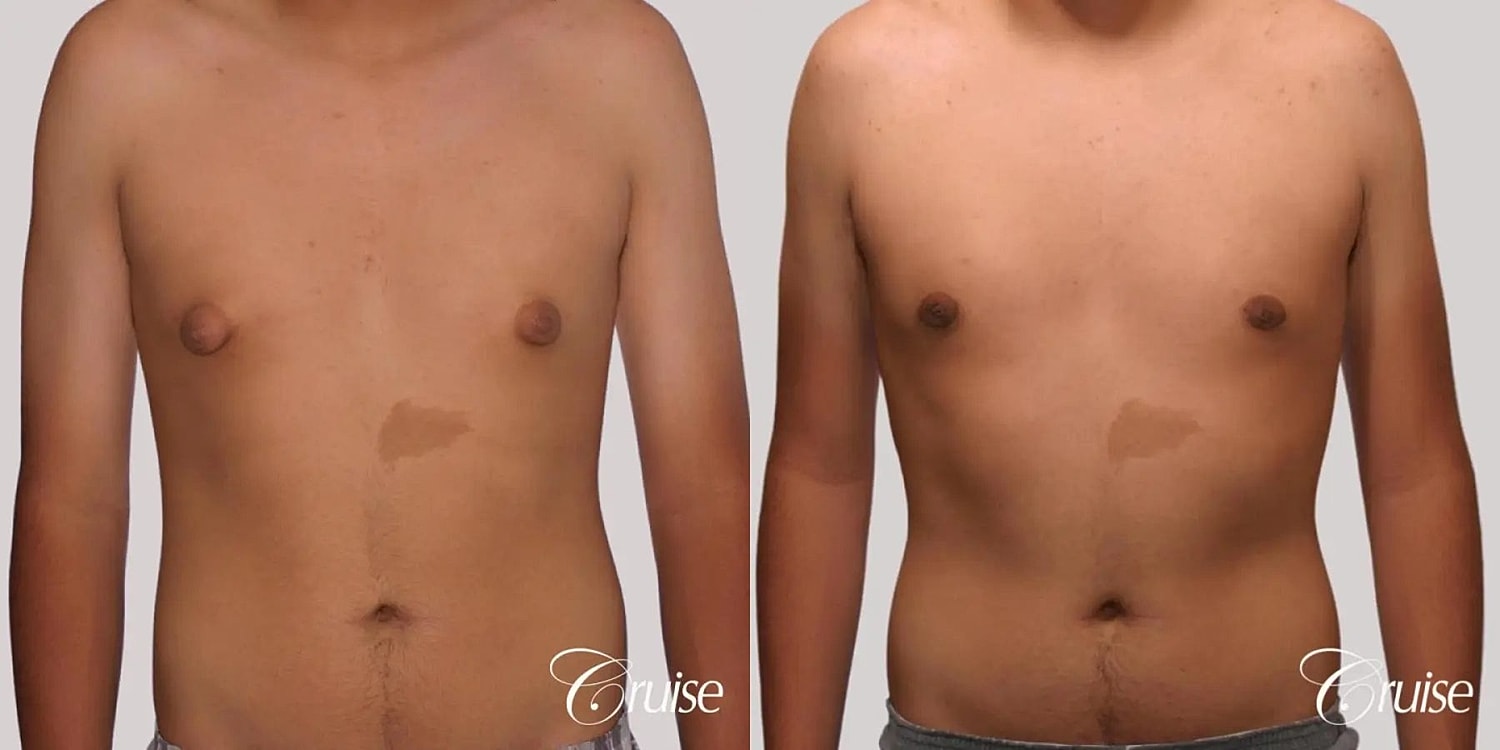 Gynecomastia Surgery Before & After