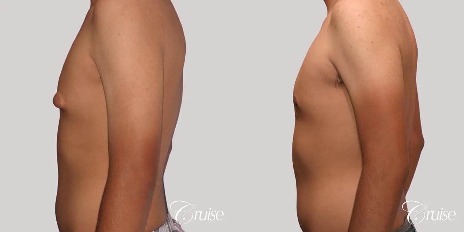 Gynecomastia Surgery Before & After