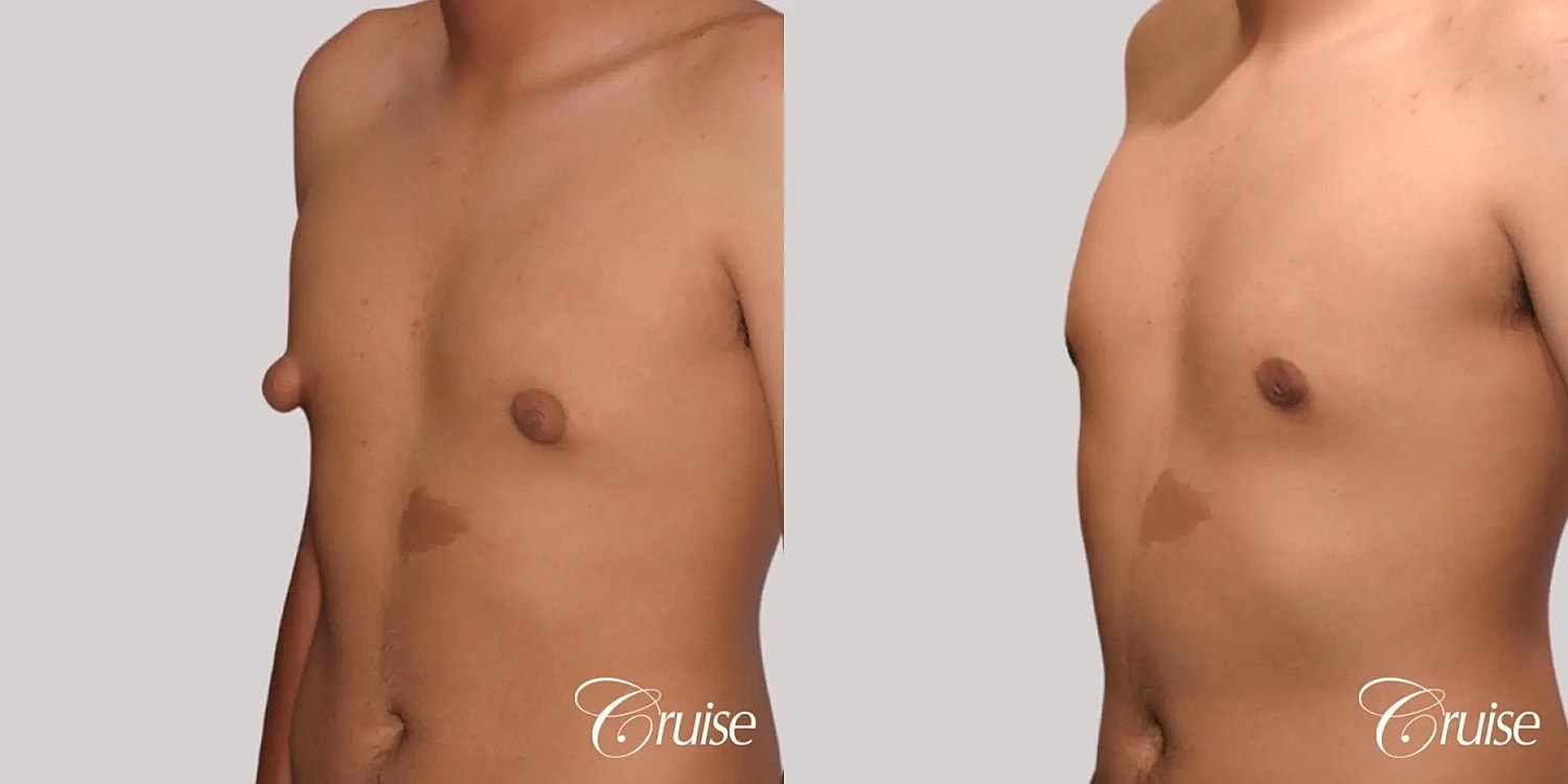 Gynecomastia Surgery Before & After