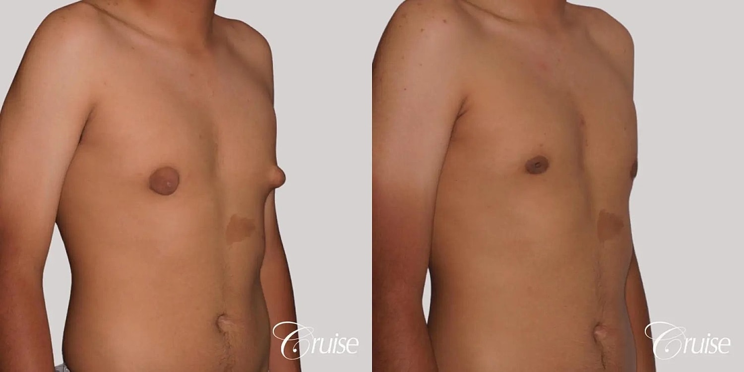 Gynecomastia Surgery Before & After