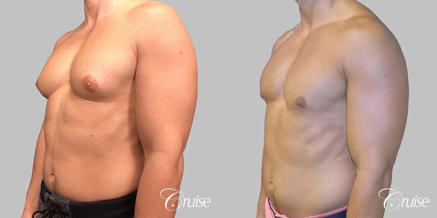 Gynecomastia Surgery Before & After