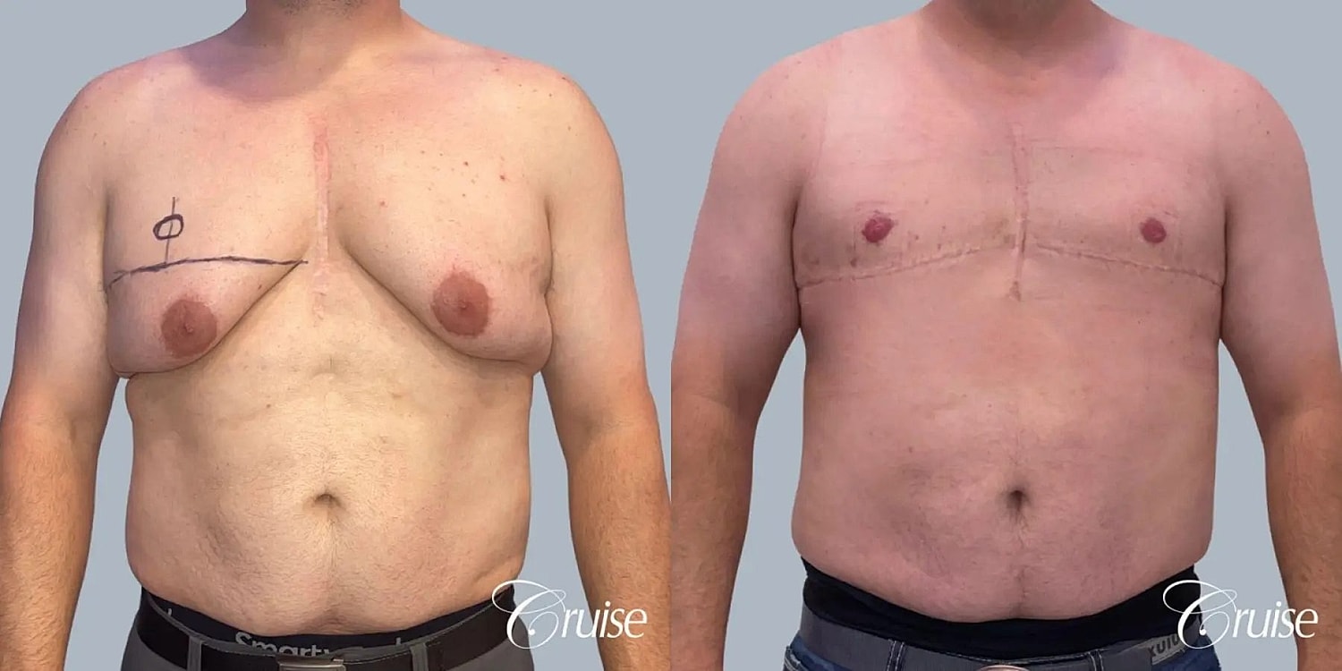 Gynecomastia Surgery Before & After