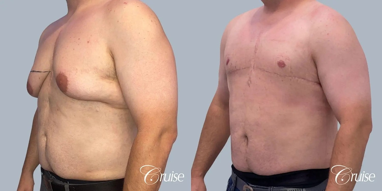 Gynecomastia Surgery Before & After